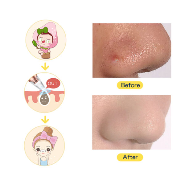 Rechargeable Blackhead Extractor with 6 Suction Heads - Image 5